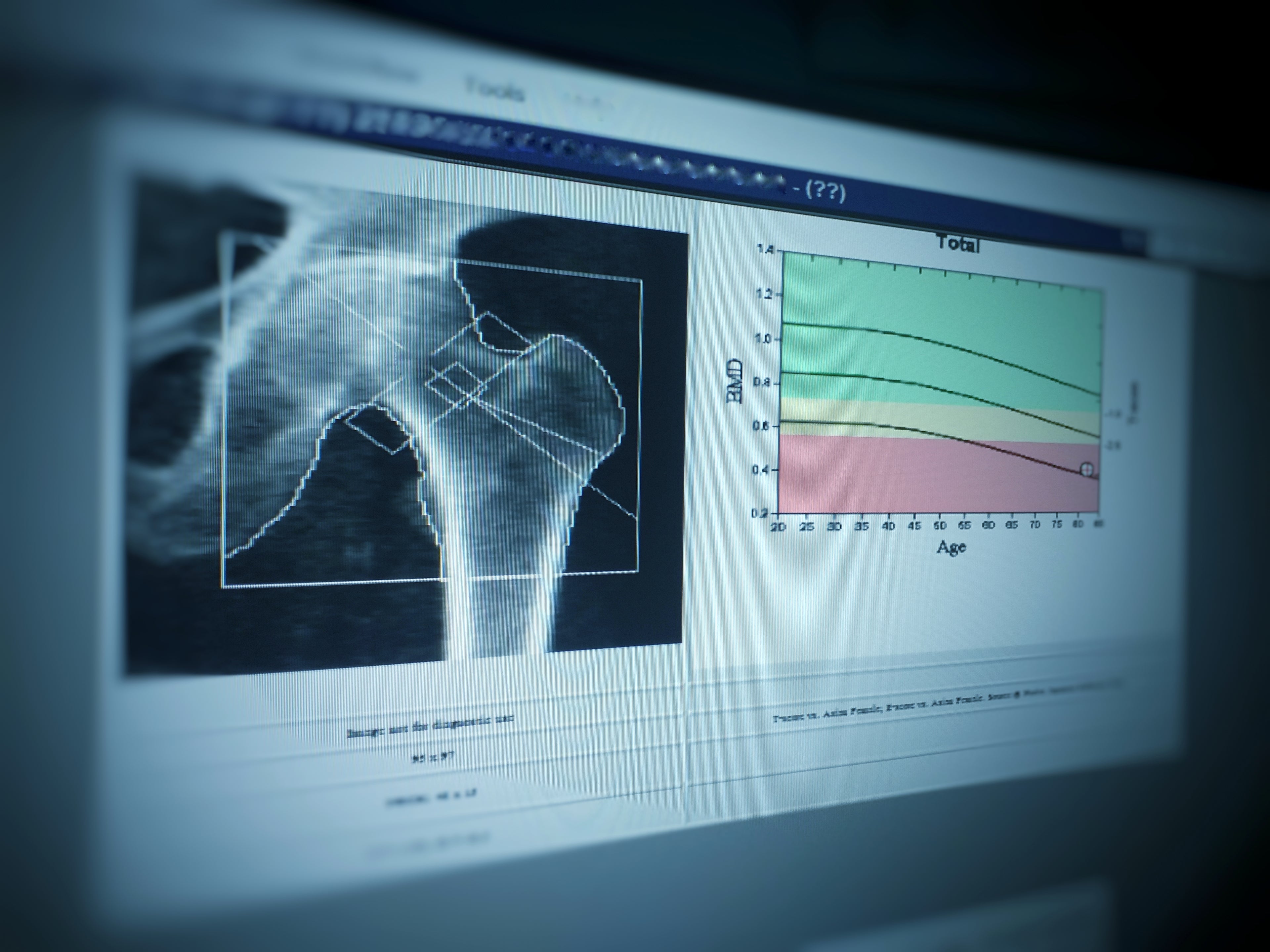 Understanding DEXA Scans and Why Bone Density Matters for Women